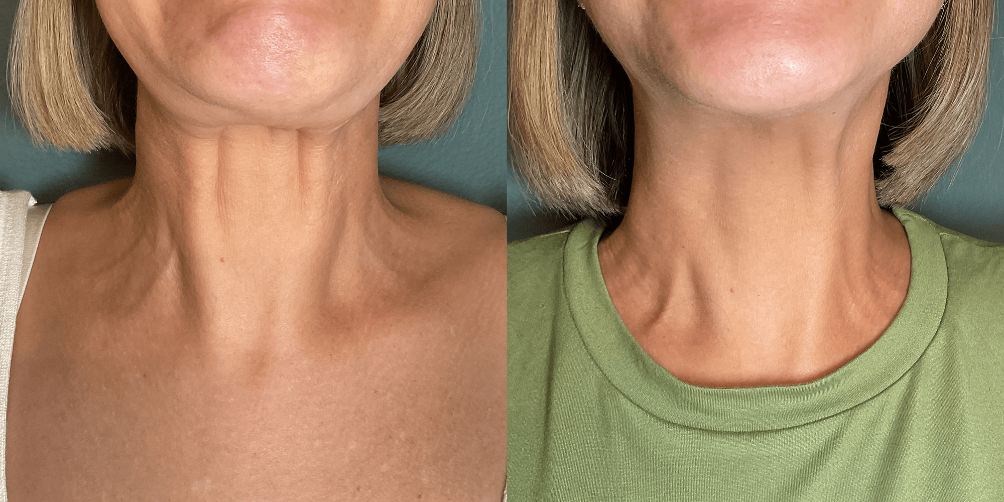 Nefertiti Neck Lift